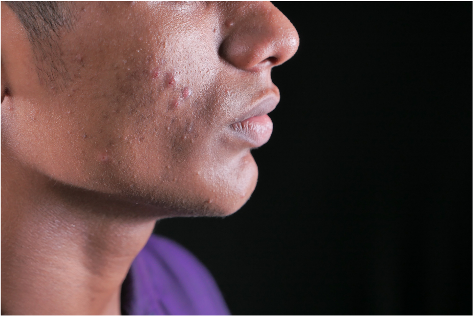 How To Shave With Acne Prone skin?